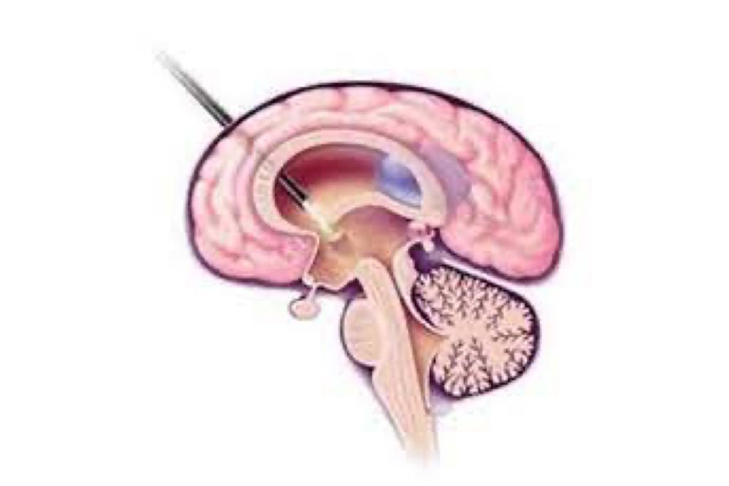 Neuroendoscopic Surgery